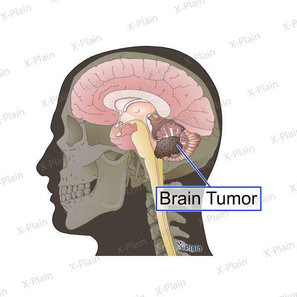 Brain Tumor with Large Blockage